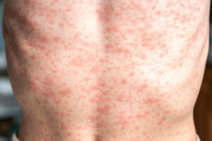 Skin rash from measles | ID Care | NJ